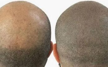 Scalp Micropigmentation Ink in Hair Loss Solutions