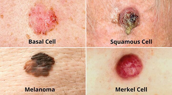 Skin Cancer Symptoms and How to Spot Them Early